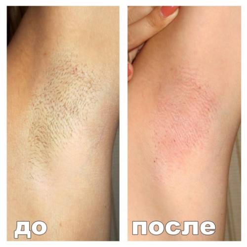 Депиляция воском всех зон